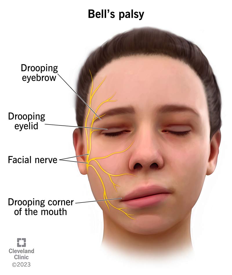 bells-palsy