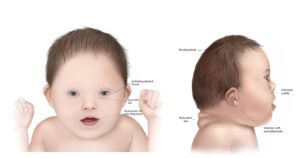 ডাউন সিনড্রোম (Down syndrome) কি ? কেন ? – অধ্যাপক ডাঃ ইমনুল ইসলাম ইমন